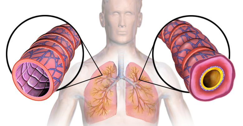 Astma to poważna choroba.