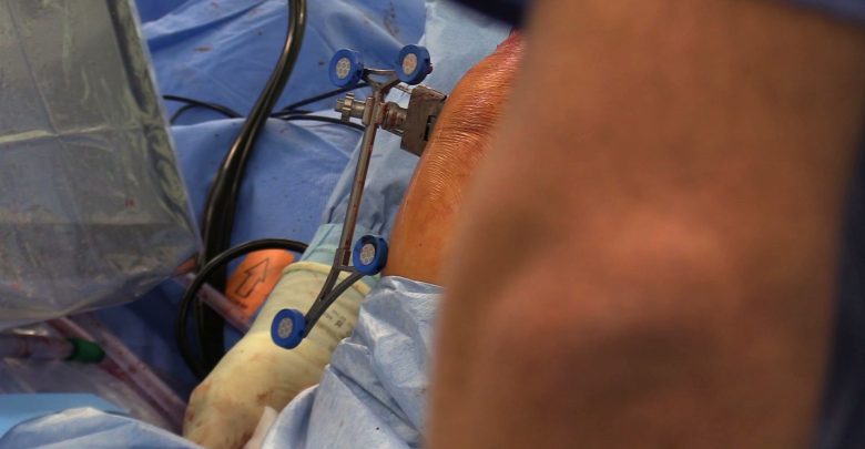 Jubilerska precyzja. Robot pomaga w Klinice Nieborowice w operacjach stawu kolanowego