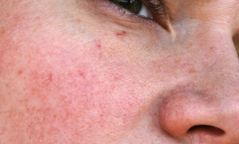 Naczynka na twarzy – sposoby na usuwanie nieestetycznej zmiany skórnej