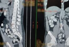 Miał w żołądku ponad kilogram kokainy. Interwencja na lotnisku/fot.KAS