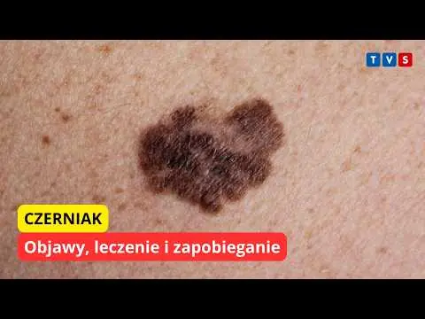 Obrazek YouTube: Czerniak. Objawy, leczenie i zapobieganie