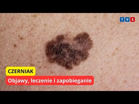 Obrazek YouTube: Czerniak. Objawy, leczenie i zapobieganie